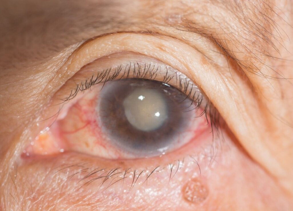 Enfermedades de la vista - Jornada de Salud Visual FINVIS