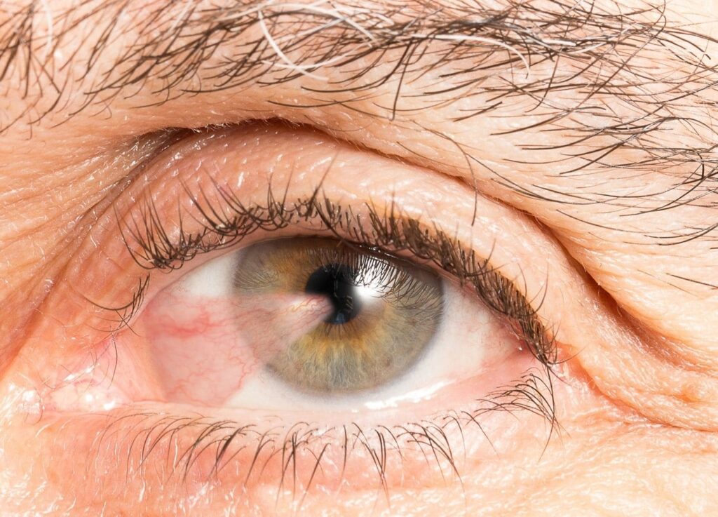 Enfermedades de la vista - Jornada de Salud Visual FINVIS